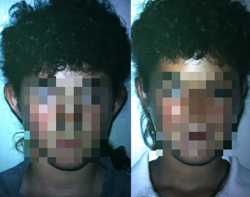 Caso real de Otoplastia en Madrid antes y después paciente 8 | Clínica Renacimiento Madrid