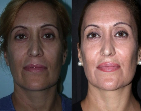 Caso real de cirugía de pómulos en Madrid antes y después, vista frontal paciente 1 | Clínica Renacimiento Madrid