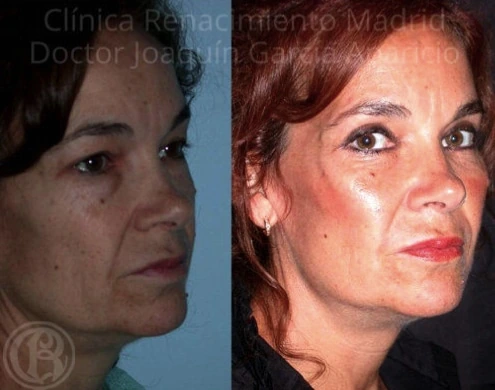 Antes y después de malarplastia en Madrid, armonización de pómulos paciente 2 | Clínica Renacimiento Madrid