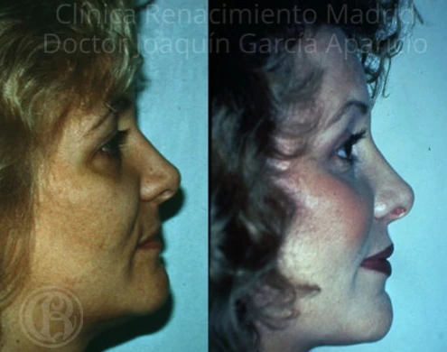Caso real de pómulos / malarplastia en Madrid antes y después, perfil paciente 4 | Clínica Renacimiento Madrid
