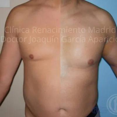 Caso real 5 de prótesis de bíceps en Madrid antes y después | Clínica Renacimiento Madrid
