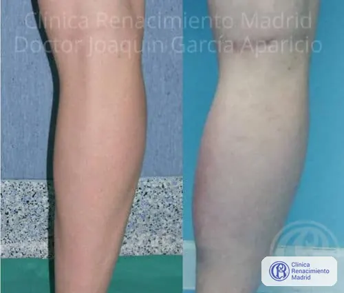 Caso real 2 de prótesis de gemelos en Madrid antes y después | Clínica Renacimiento Madrid