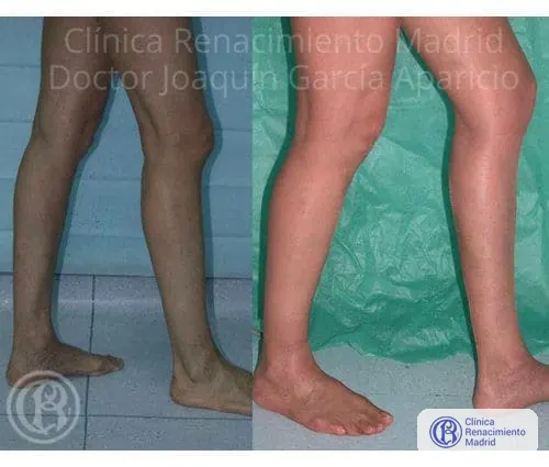 Caso real 4 de prótesis de gemelos en Madrid antes y después | Clínica Renacimiento Madrid