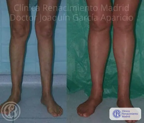 Caso real 6 de prótesis de gemelos en Madrid antes y después | Clínica Renacimiento Madrid