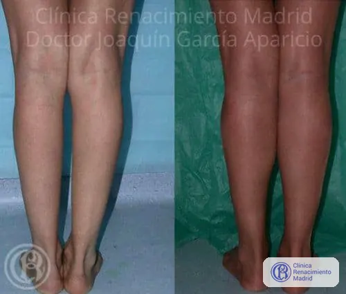 Caso real 7 de prótesis de gemelos en Madrid antes y después | Clínica Renacimiento Madrid