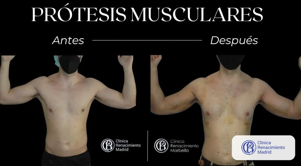 Caso real 2 de prótesis de pectorales en Madrid antes y después con brazos en flexión | Clínica Renacimiento Madrid
