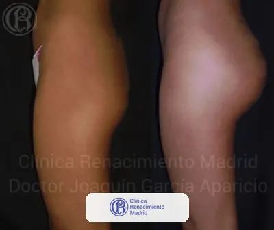 Caso real de prótesis de glúteos en Madrid antes y después paciente 5 | Clínica Renacimiento Madrid