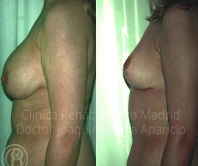 Caso real de reducción de senos en Madrid antes y después paciente 3 | Clínica Renacimiento Madrid