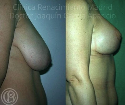 Caso real de reducción de senos en Madrid antes y después paciente 4 | Clínica Renacimiento Madrid