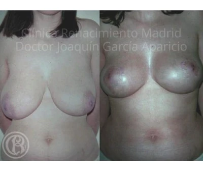 Caso real de reducción de senos en Madrid antes y después paciente 6 | Clínica Renacimiento Madrid