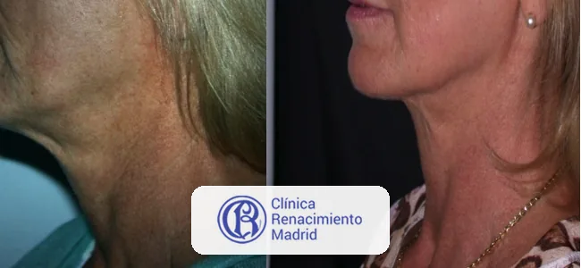 Caso real de rejuvenecimiento de cuello en Madrid antes y después paciente 1 | Clínica Renacimiento Madrid