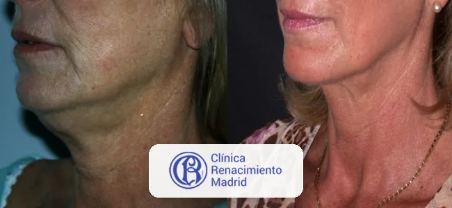 Antes y después de rejuvenecimiento de cuello en Madrid caso real 2 | Clínica Renacimiento Madrid