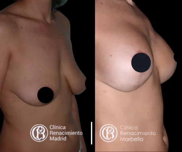 Breast augmentation case in Madrid before and after patient 4 | Clínica Renacimiento Madrid