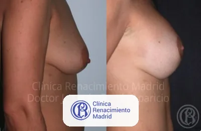 Cas réel de lifting mammaire mastopexie à Madrid avant et après patiente 8 | Clínica Renacimiento Madrid