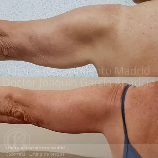 Antes y después de lifting de brazos en Clínica Renacimiento Madrid caso real 1