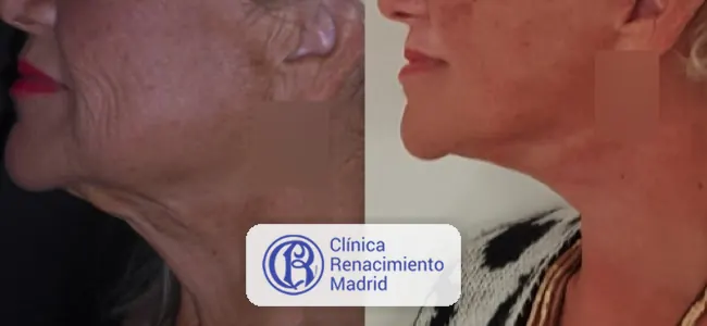 Resultado real de lifting de cuello en Madrid caso real 3 | Clínica Renacimiento Madrid