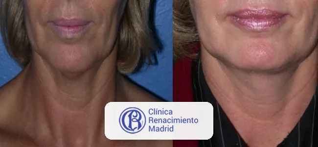Rejuvenecimiento cervical en Madrid caso real antes y después 3 | Clínica Renacimiento Madrid