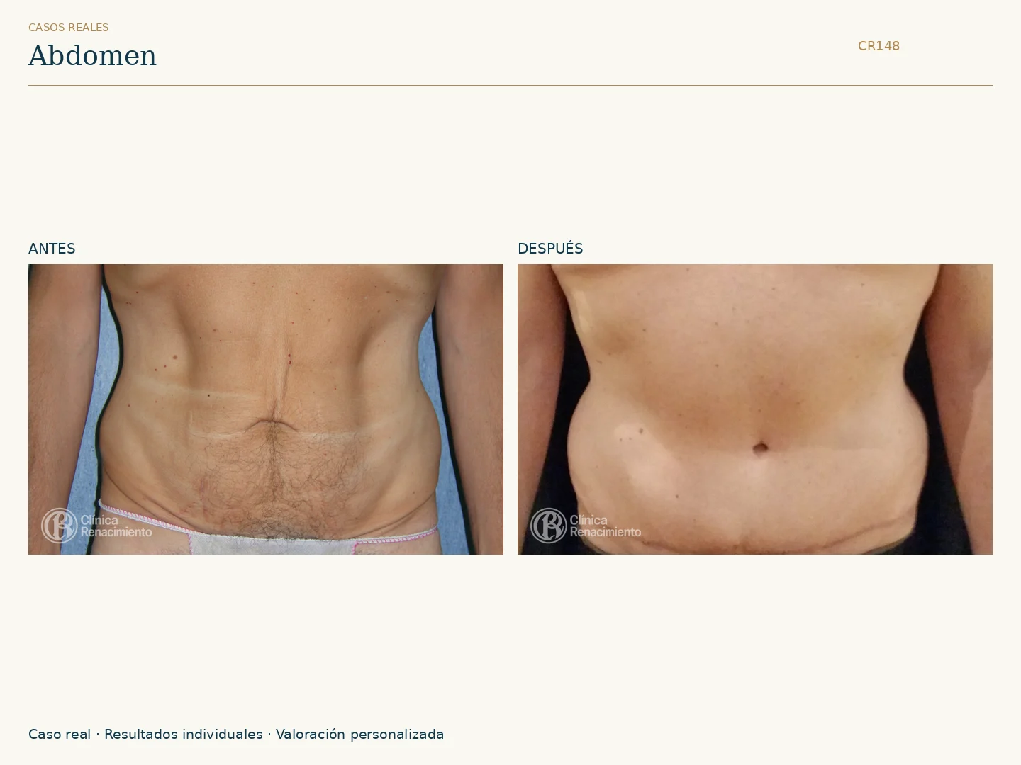Abdomen: antes y después, vista frontal. Caso CR148 de Clínica Renacimiento Madrid.