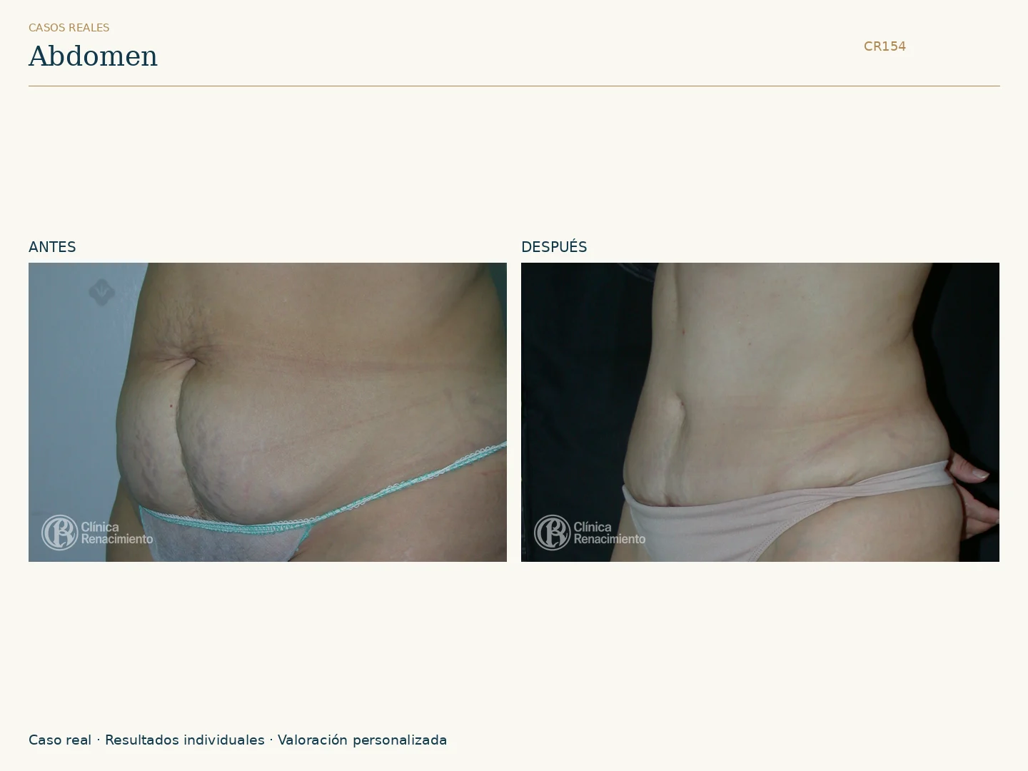 Abdomen: antes y después, vista oblicua izquierda. Caso CR154 de Clínica Renacimiento Madrid.