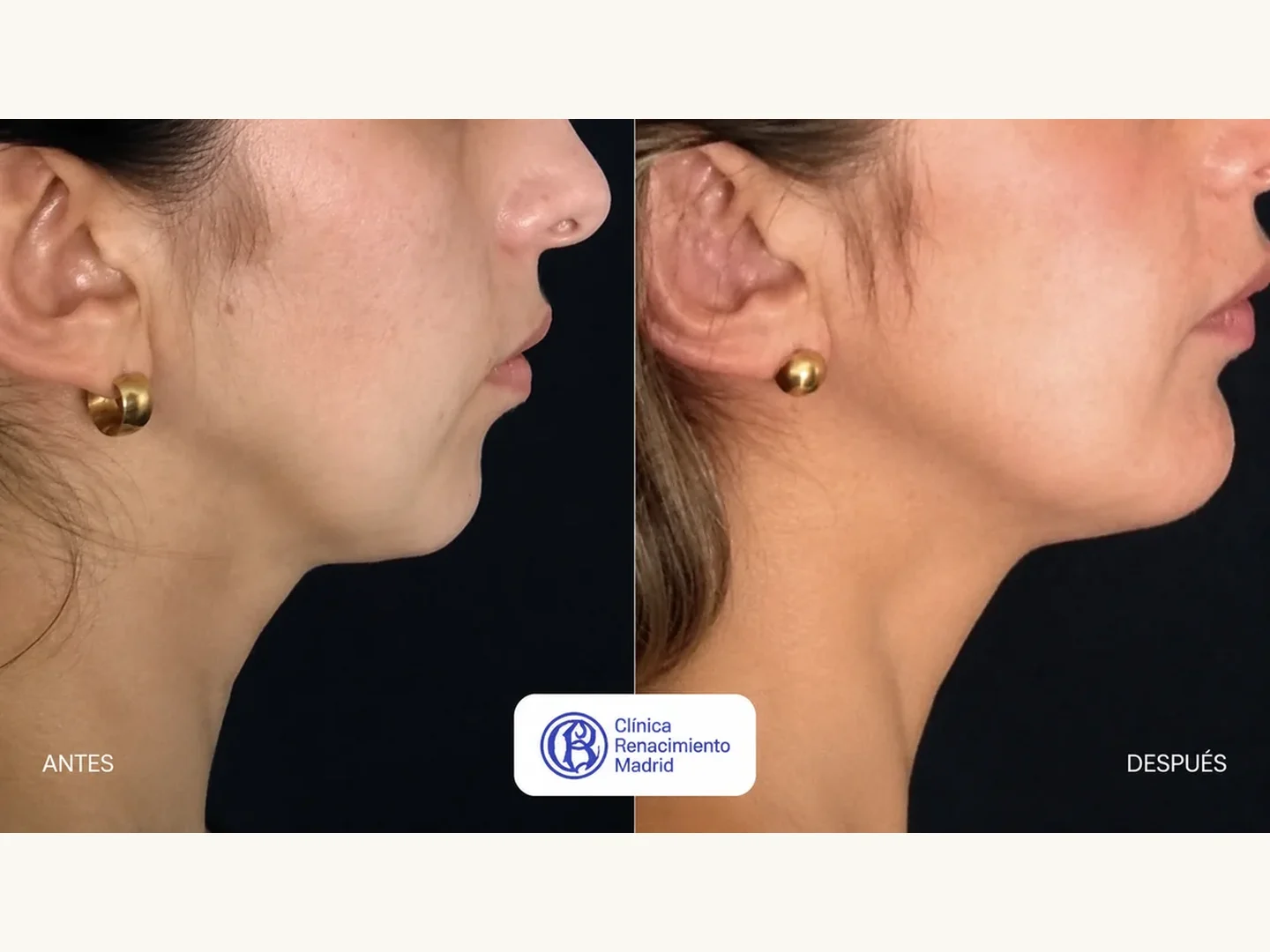 Caso real de cirugía de mentón en Madrid antes y después, perfil femenino con mejora de la línea mandibular | Clínica Renacimiento Madrid
