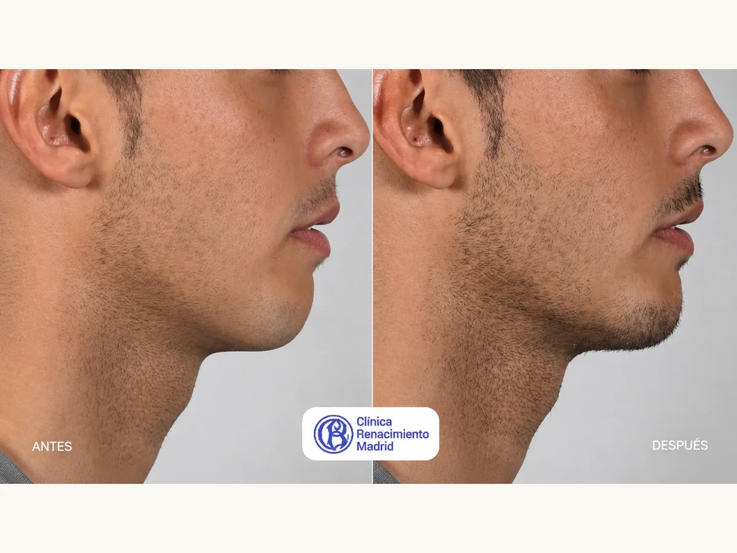 Caso real de mentoplastia masculina en Madrid antes y después, perfil y mentón proporcionado | Clínica Renacimiento Madrid