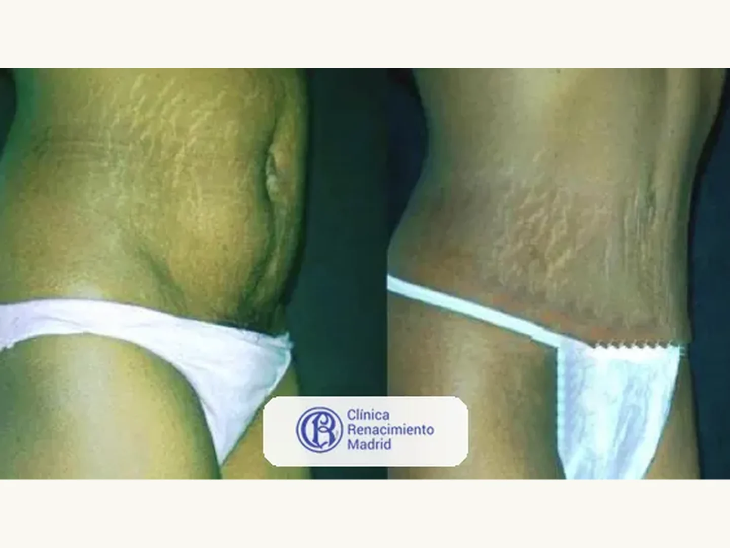 Abdomen: Caso real de abdominoplastia en Madrid antes y después paciente 5 | Clínica Renacimiento Madrid