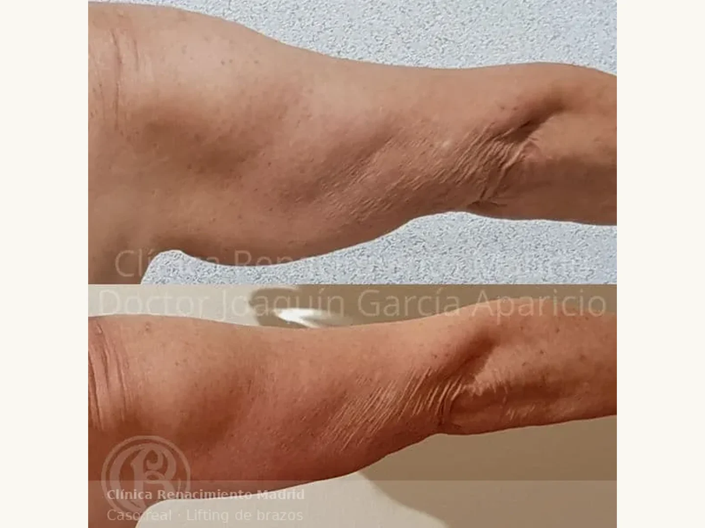 Lifting de brazos: Antes y después de redefinición de brazos mediante braquioplastia en Madrid