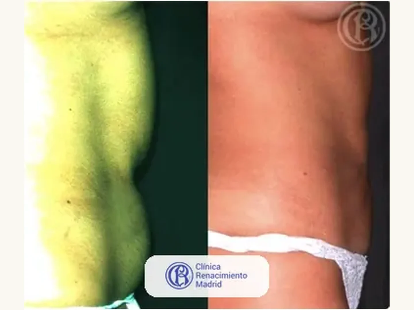 Lipoescultura integral HD: Caso real de lipoescultura y liposucción en Madrid antes y después caso 4 | Clínica Renacimiento Madrid
