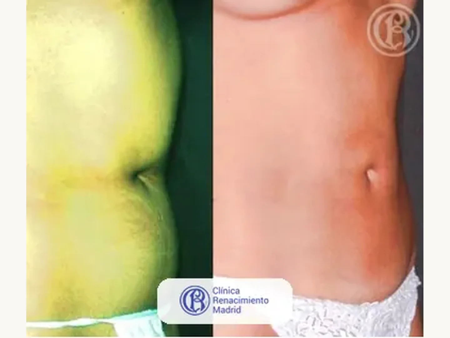 Lipoescultura integral HD: Caso real de lipoescultura y liposucción en Madrid antes y después caso 3 | Clínica Renacimiento Madrid
