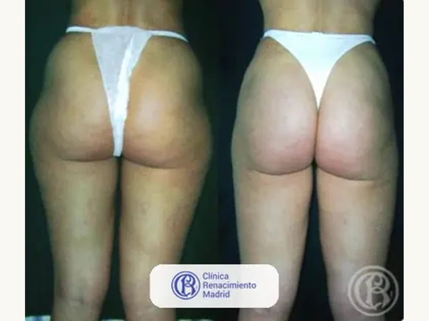 Lipoescultura integral HD: Caso real de lipoescultura y liposucción en Madrid antes y después caso 2 | Clínica Renacimiento Madrid