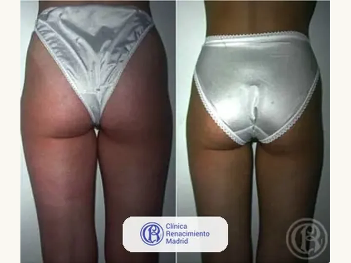 Lipoescultura integral HD: Caso real de lipoescultura y liposucción en Madrid antes y después caso 5 | Clínica Renacimiento Madrid