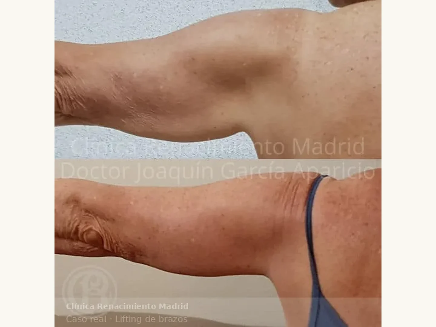 Antes y después de lifting de brazos en Clínica Renacimiento Madrid caso real 1