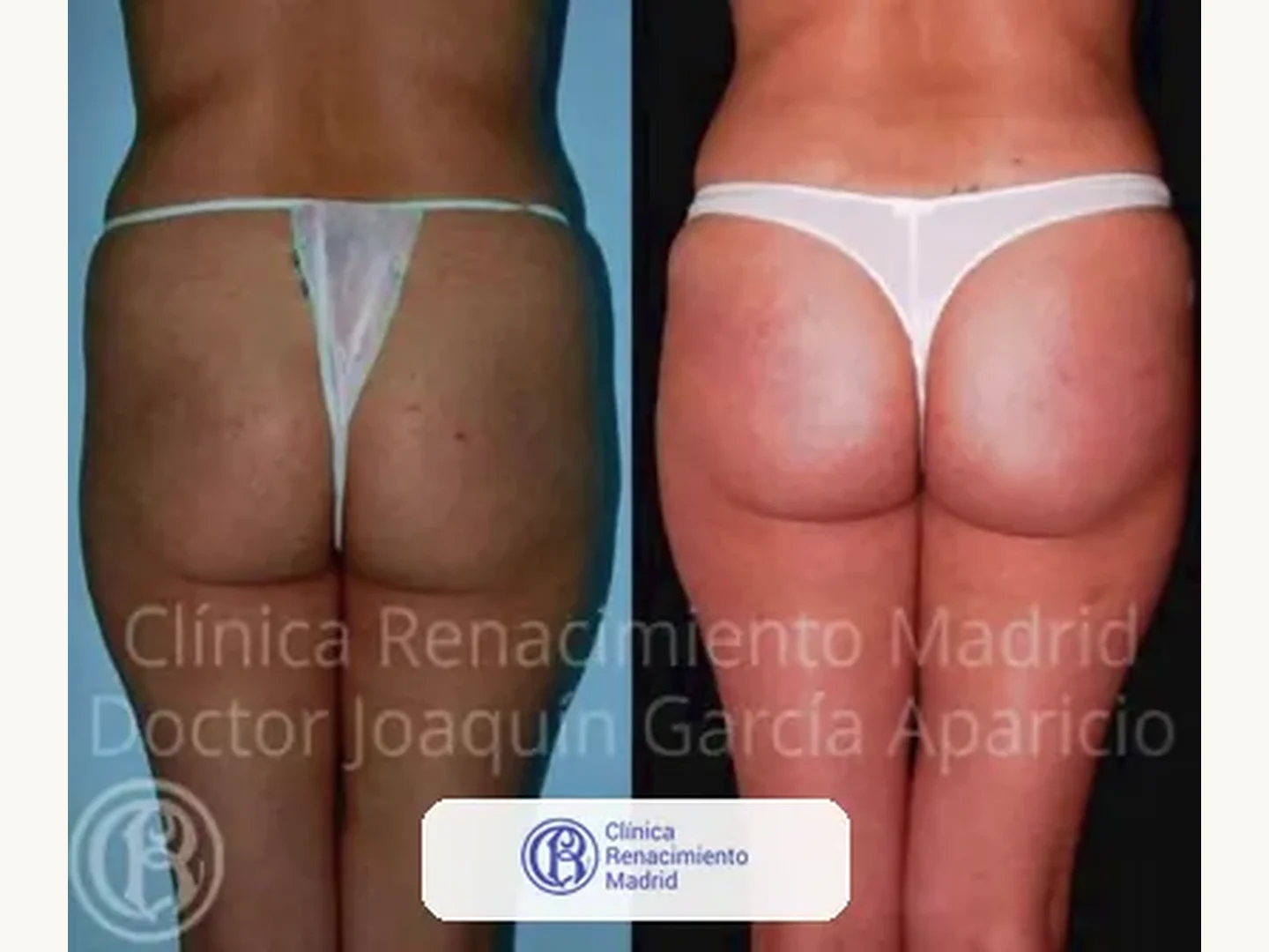 Caso real de prótesis de glúteos en Madrid antes y después paciente 9 | Clínica Renacimiento Madrid