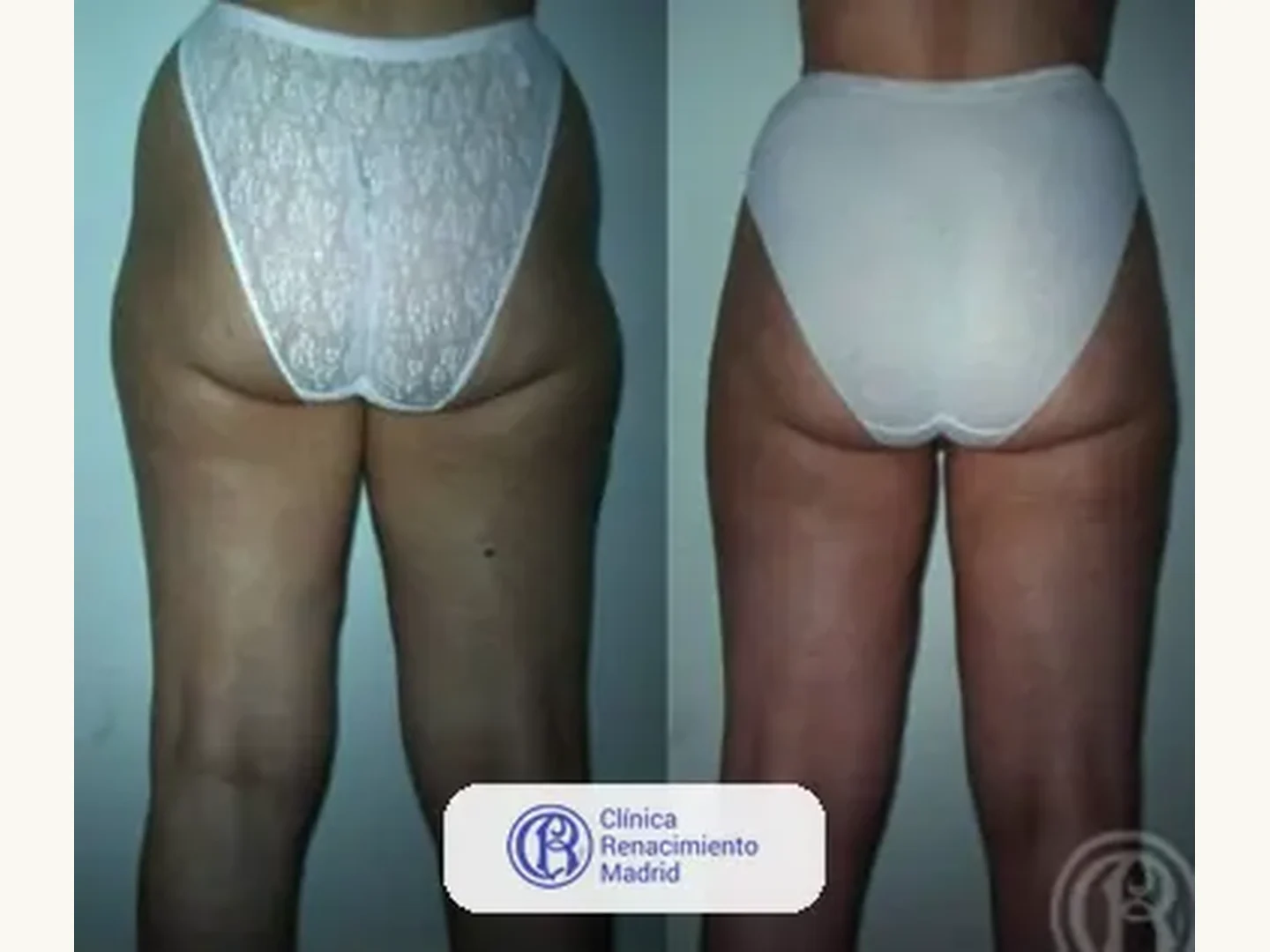 Lipoescultura integral HD: Caso real de lipoescultura y liposucción en Madrid antes y después caso 6 | Clínica Renacimiento Madrid