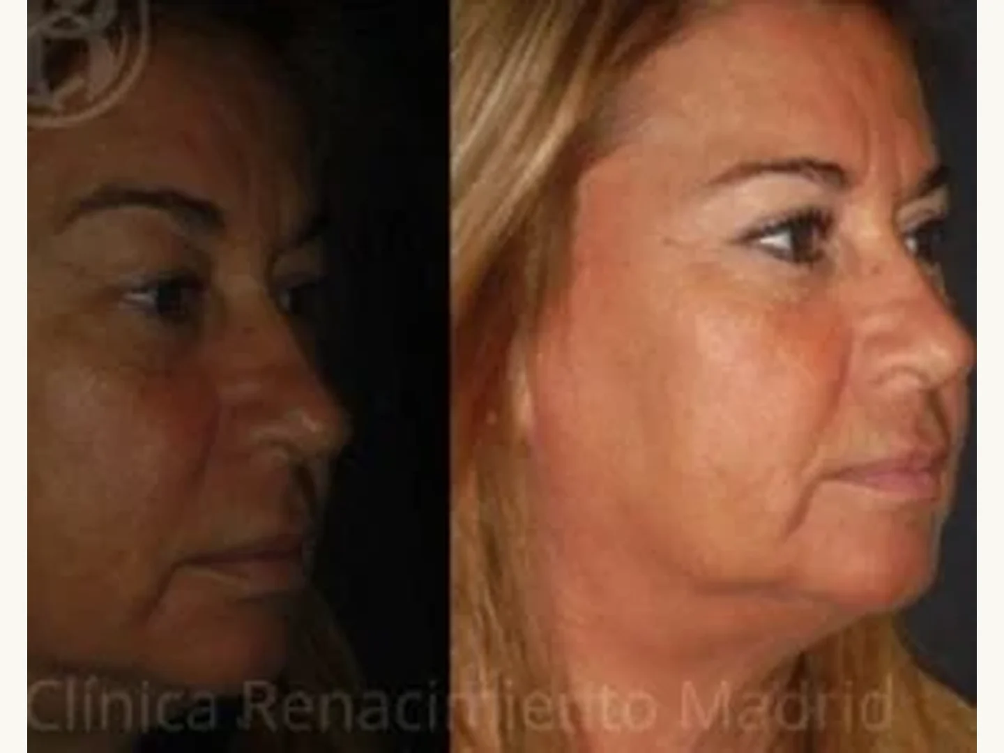 Párpados: Caso real de blefaroplastia estética en Madrid antes y después paciente 7 | Clínica Renacimiento Madrid