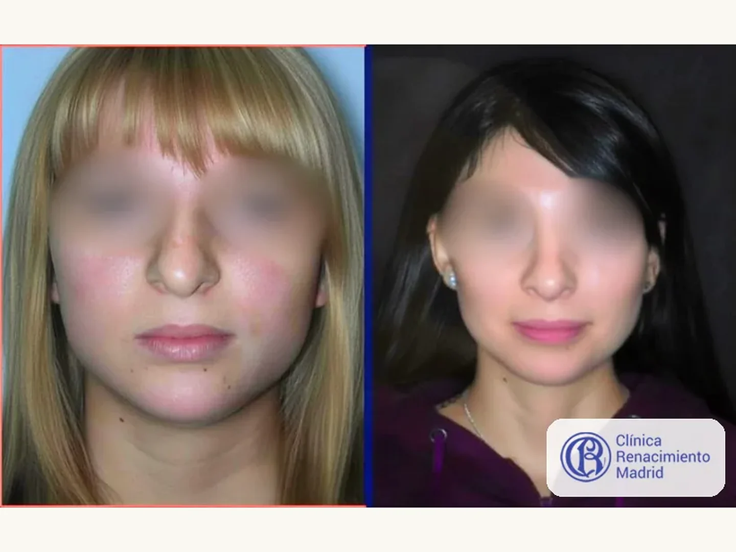 Caso real de Bichectomía / Bolas de Bichat en Madrid vista frontal antes y después | Clínica Renacimiento Madrid