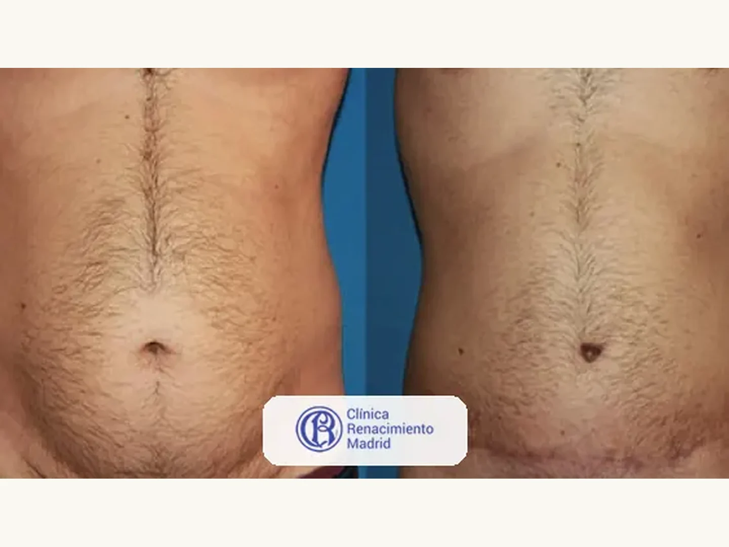 Abdomen: Caso real de abdominoplastia en Madrid antes y después paciente 6 | Clínica Renacimiento Madrid