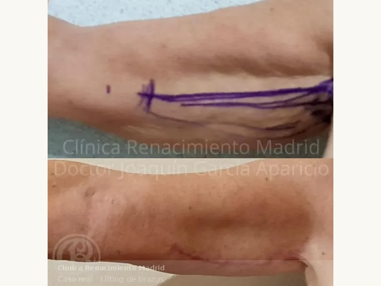 Planificación y resultado de lifting de brazos con cicatriz controlada en Clínica Renacimiento