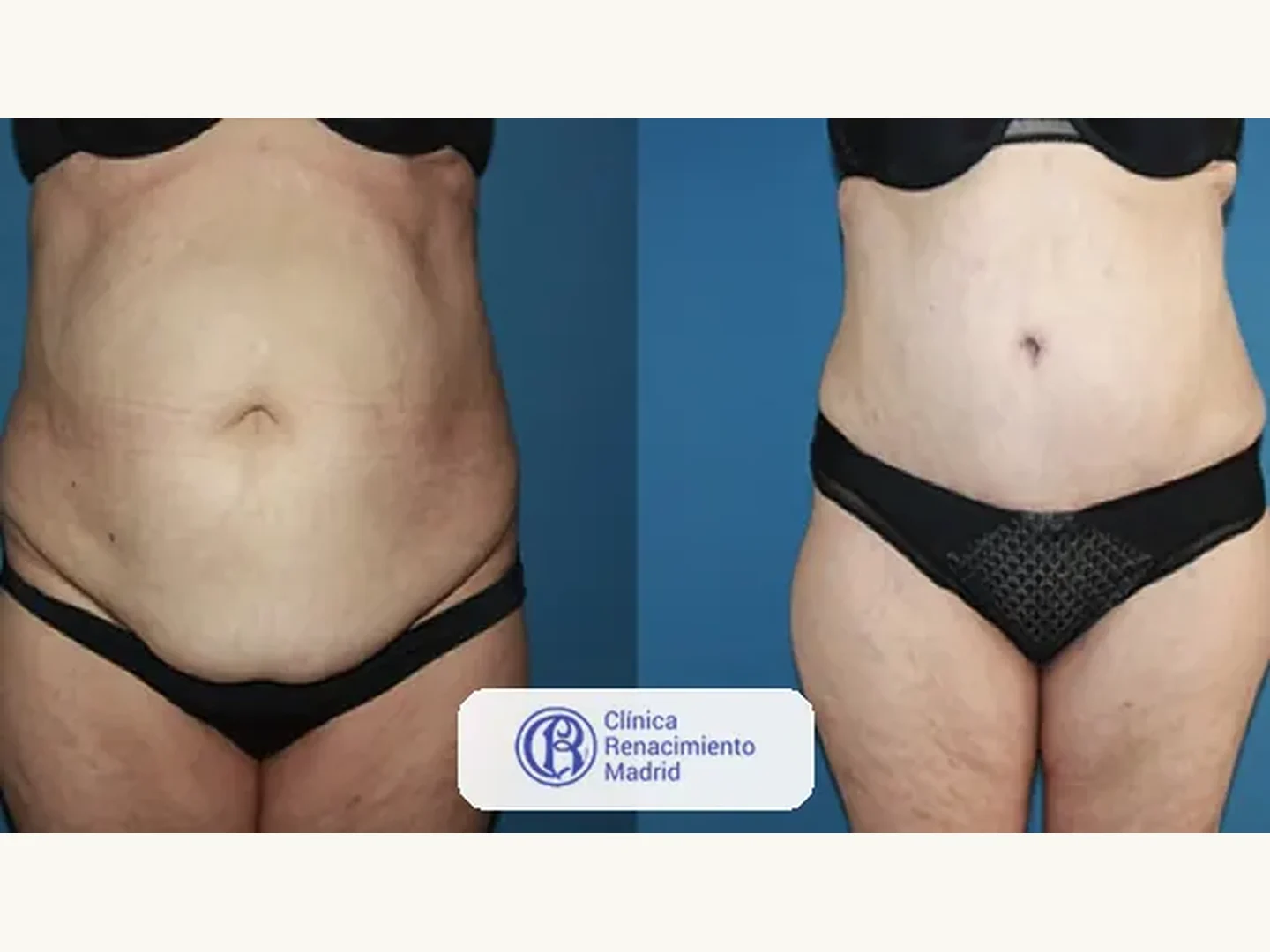 Abdomen: Caso real de abdominoplastia en Madrid antes y después paciente 1 | Clínica Renacimiento Madrid