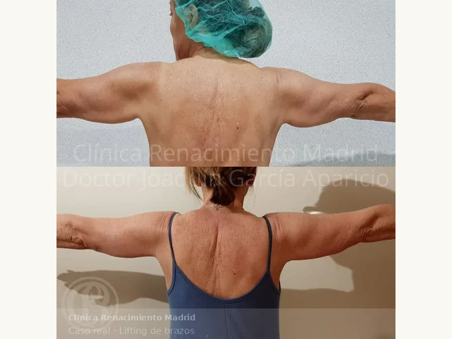 Caso real de braquioplastia o lifting de brazos en Clínica Renacimiento Madrid y Marbella