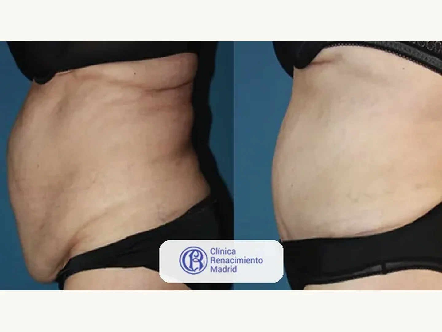 Abdomen: Caso real de abdominoplastia en Madrid antes y después paciente 2 | Clínica Renacimiento Madrid