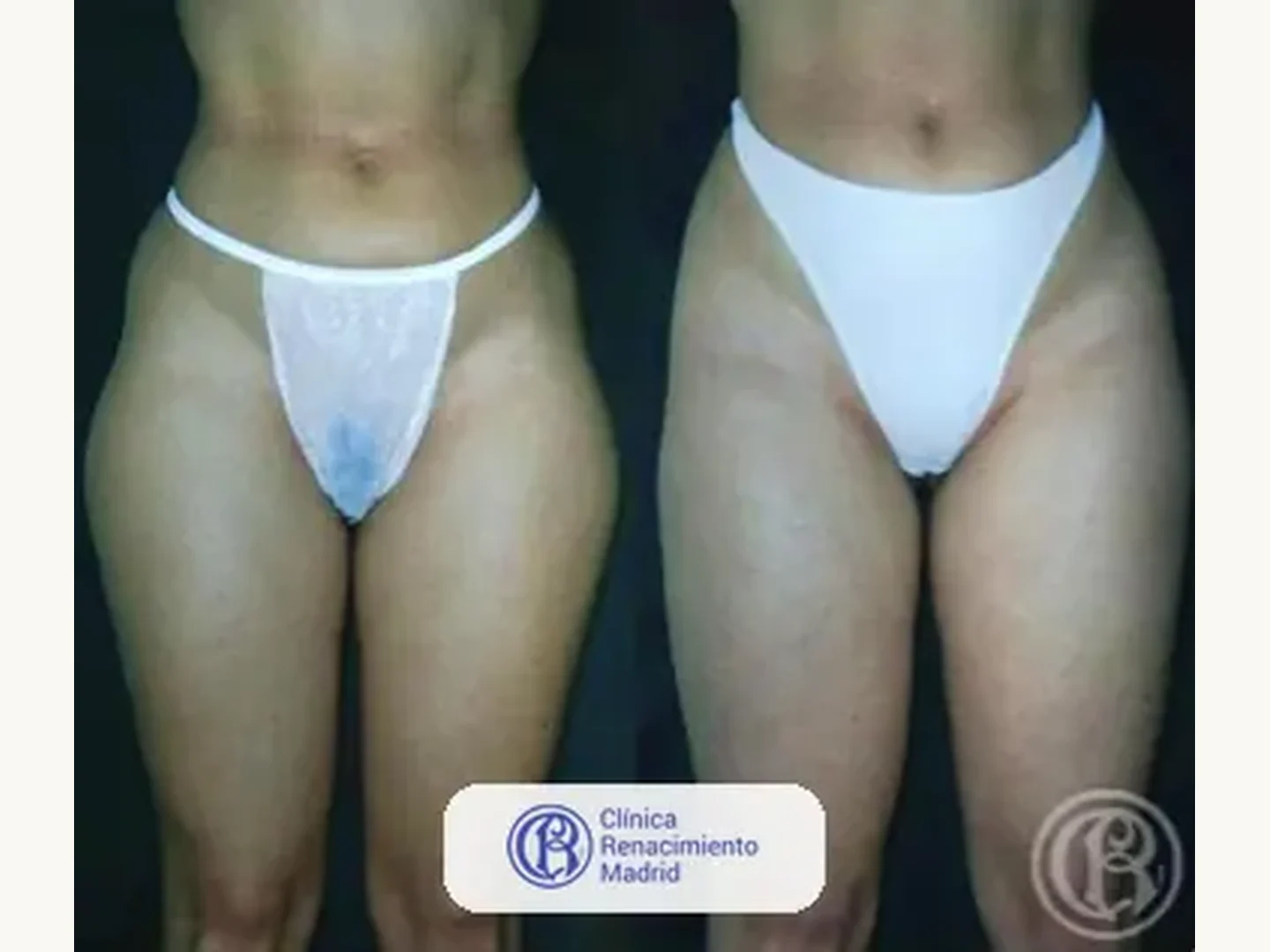Lipoescultura integral HD: Caso real de lipoescultura y liposucción en Madrid antes y después caso 1 | Clínica Renacimiento Madrid