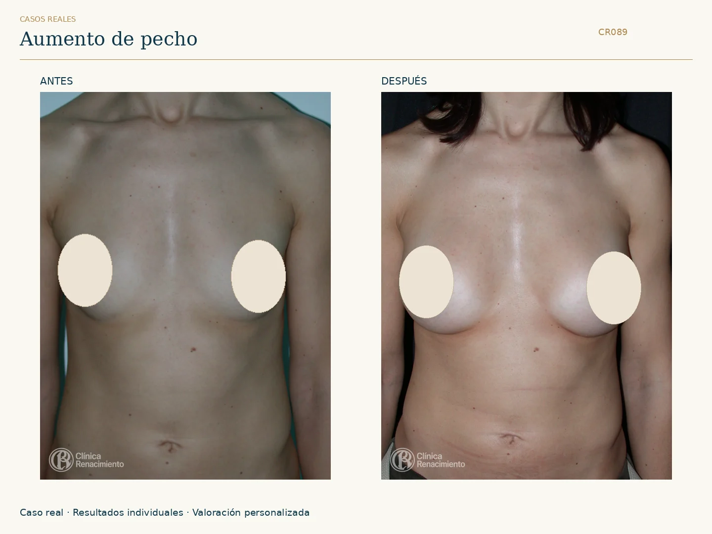 Aumento de senos: antes y después, vista frontal. Caso CR089 de Clínica Renacimiento Madrid.