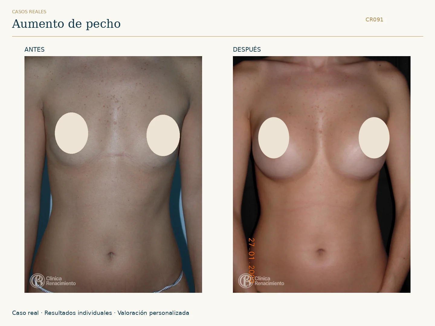 Aumento de senos: antes y después, vista frontal. Caso CR091 de Clínica Renacimiento Madrid.