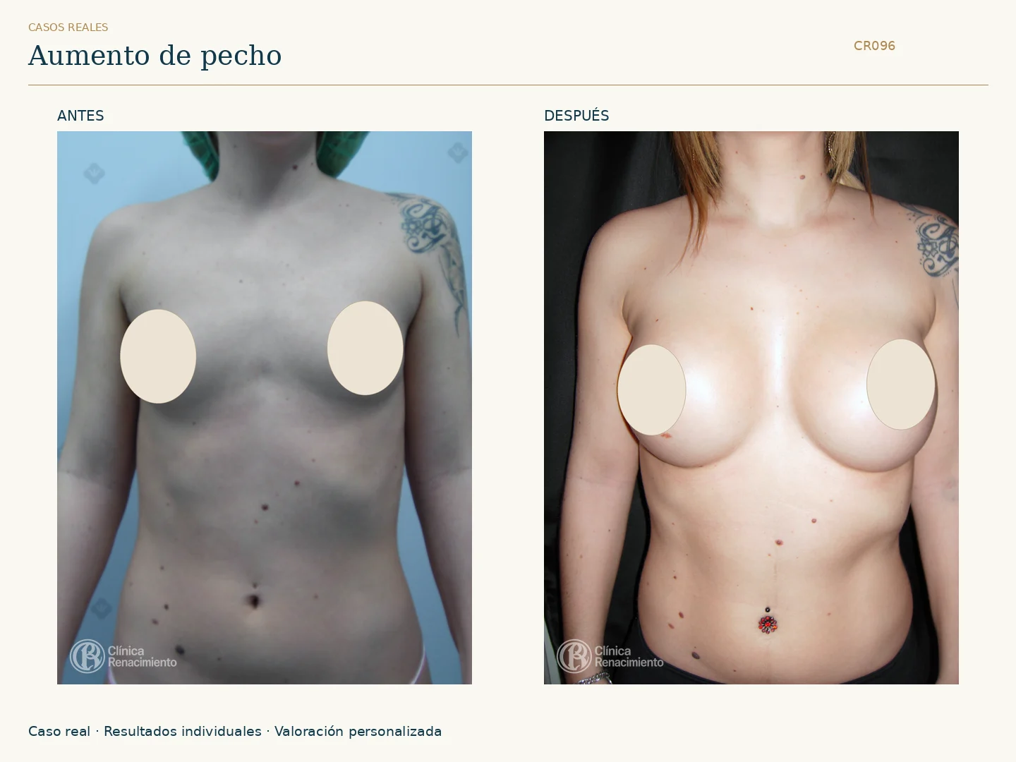 Aumento de senos: antes y después, vista frontal. Caso CR096 de Clínica Renacimiento Madrid.