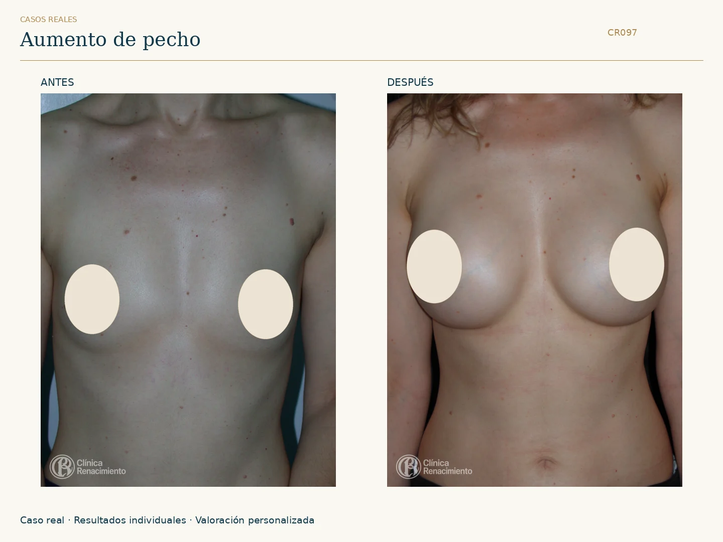 Aumento de senos: antes y después, vista frontal. Caso CR097 de Clínica Renacimiento Madrid.