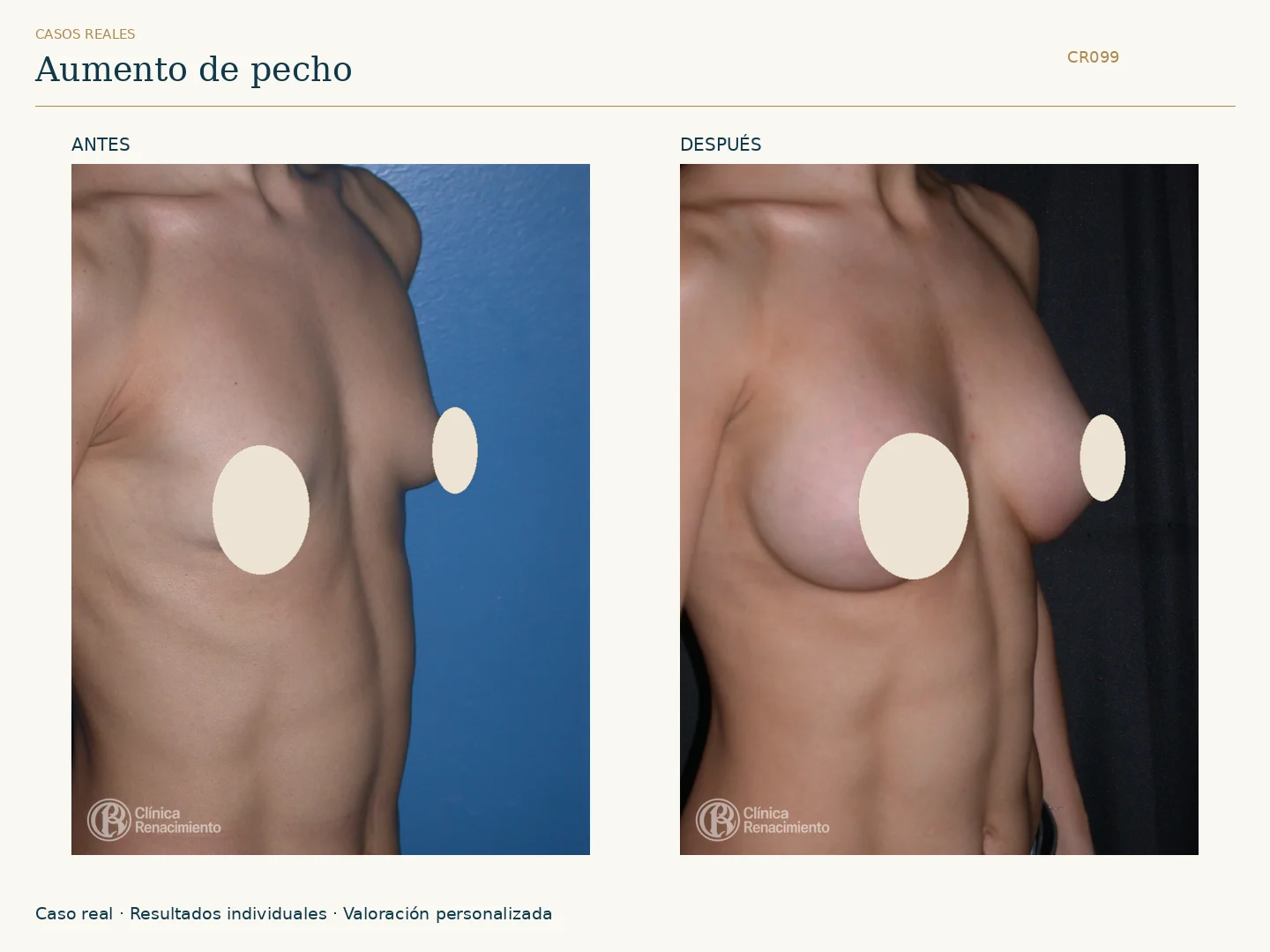 Aumento de senos: antes y después, vista oblicua derecha. Caso CR099 de Clínica Renacimiento Madrid.