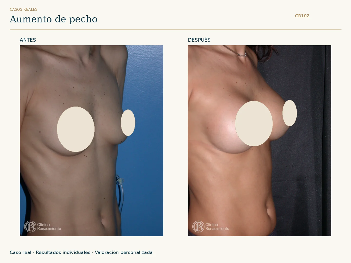 Aumento de senos: antes y después, vista oblicua derecha. Caso CR102 de Clínica Renacimiento Madrid.