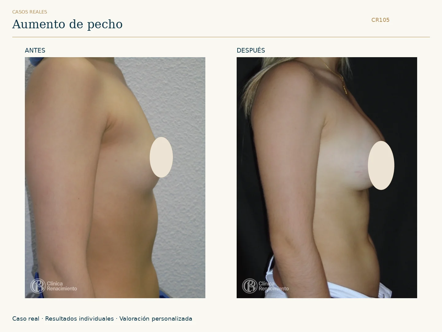 Aumento de senos: antes y después, vista perfil derecho. Caso CR105 de Clínica Renacimiento Madrid.