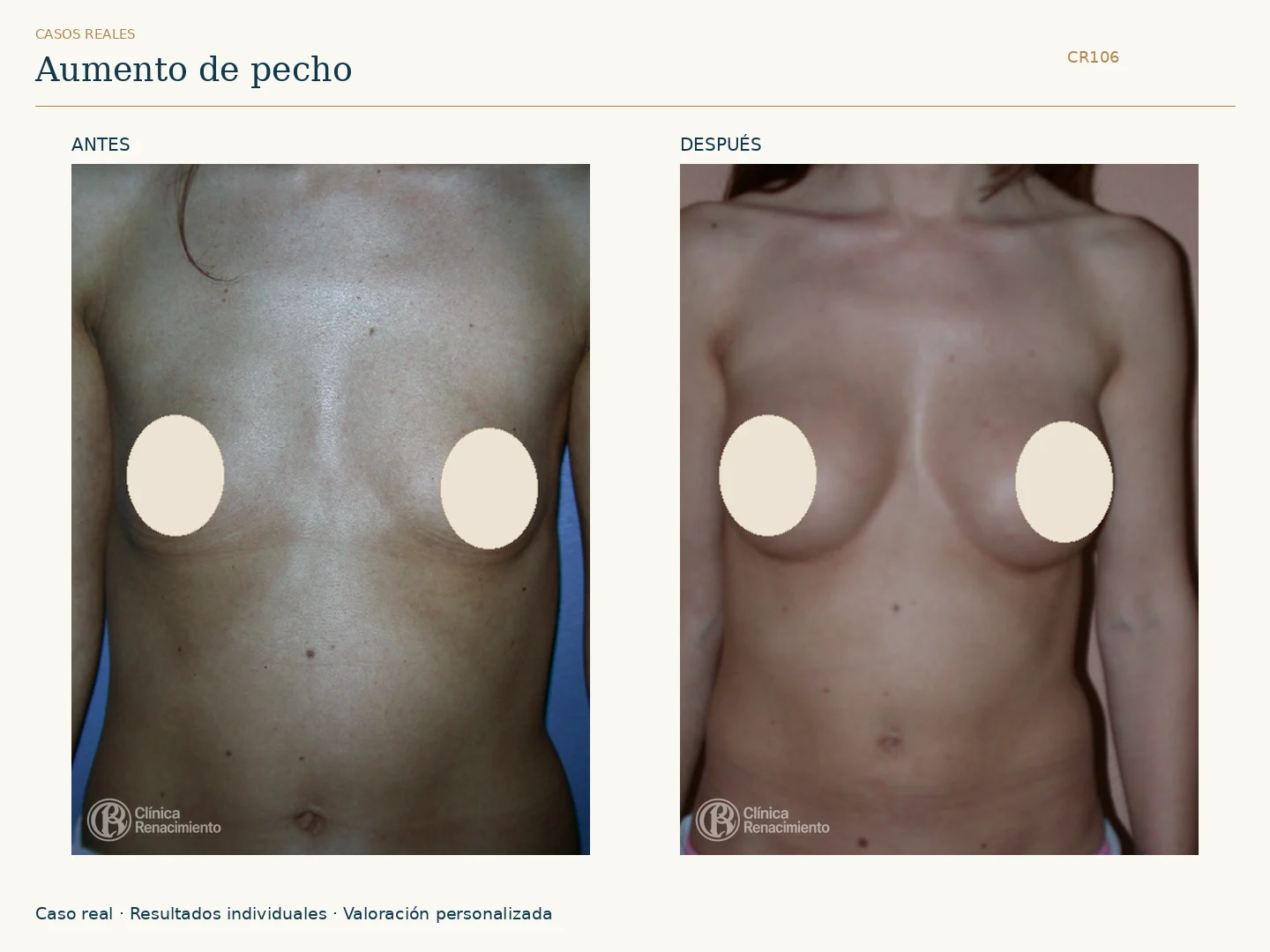 Aumento de senos: antes y después, vista frontal. Caso CR106 de Clínica Renacimiento Madrid.